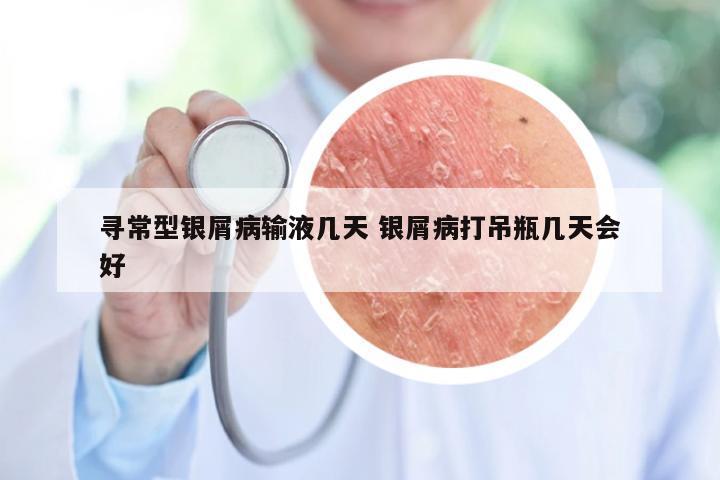 寻常型银屑病输液几天 银屑病打吊瓶几天会好