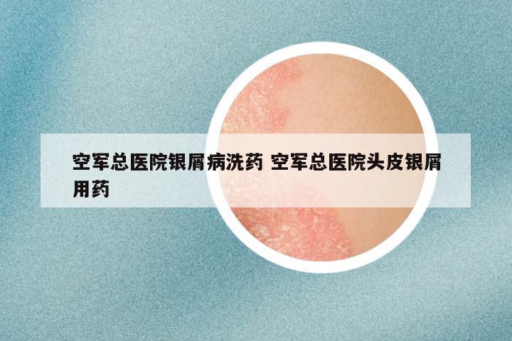 空军总医院银屑病洗药 空军总医院头皮银屑用药