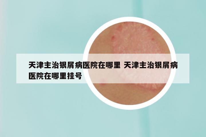 天津主治银屑病医院在哪里 天津主治银屑病医院在哪里挂号