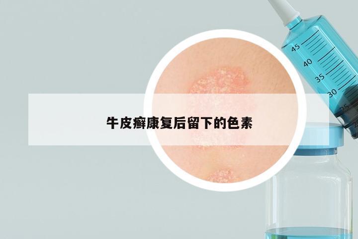 牛皮癣康复后留下的色素