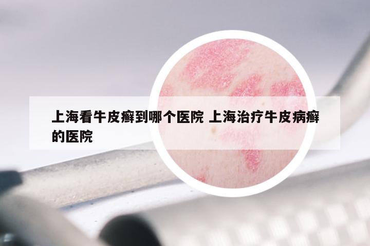 上海看牛皮癣到哪个医院 上海治疗牛皮病癣的医院