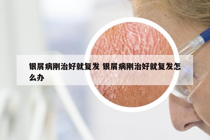 银屑病刚治好就复发 银屑病刚治好就复发怎么办