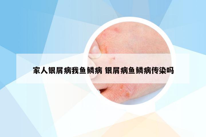 家人银屑病我鱼鳞病 银屑病鱼鳞病传染吗