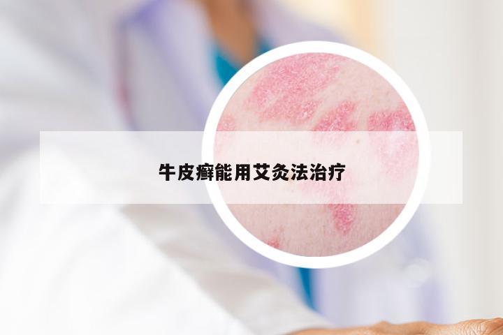 牛皮癣能用艾灸法治疗