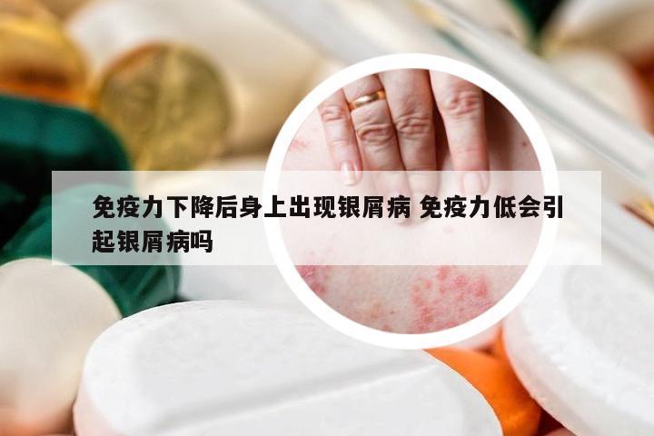 免疫力下降后身上出现银屑病 免疫力低会引起银屑病吗