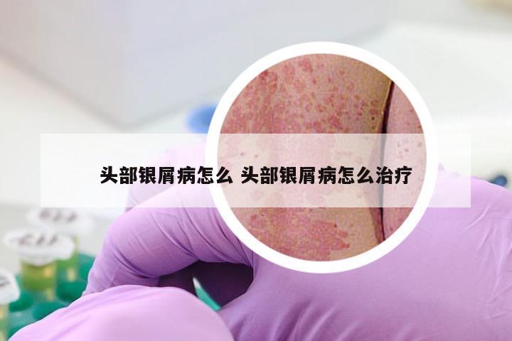 头部银屑病怎么 头部银屑病怎么治疗