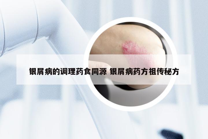 银屑病的调理药食同源 银屑病药方祖传秘方