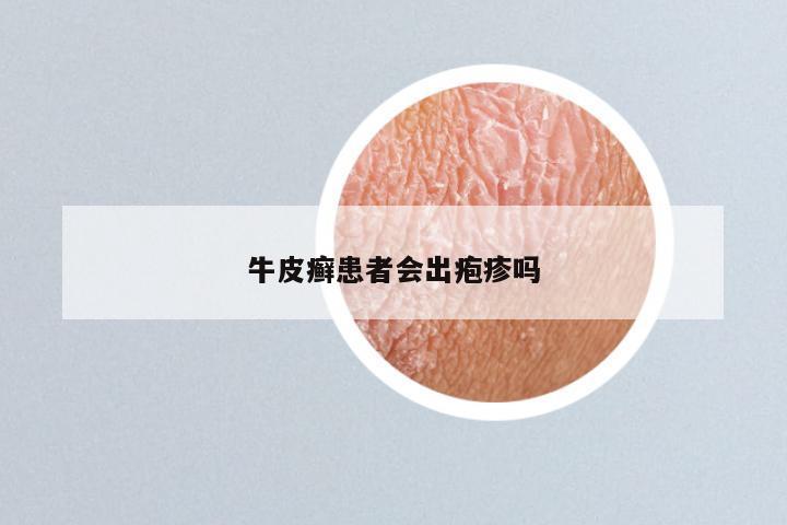 牛皮癣患者会出疱疹吗