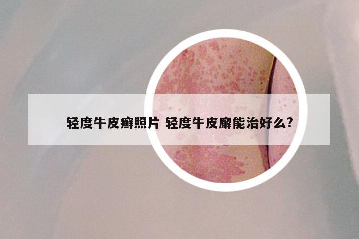 轻度牛皮癣照片 轻度牛皮廨能治好么?