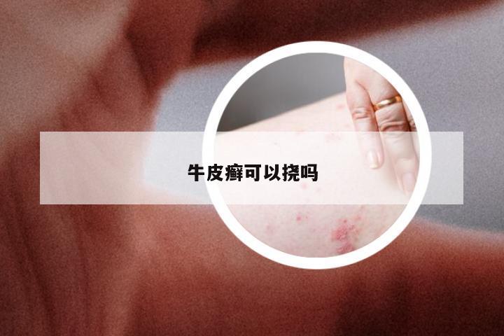 牛皮癣可以挠吗