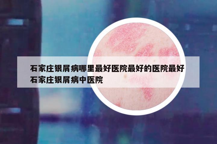 石家庄银屑病哪里最好医院最好的医院最好 石家庄银屑病中医院
