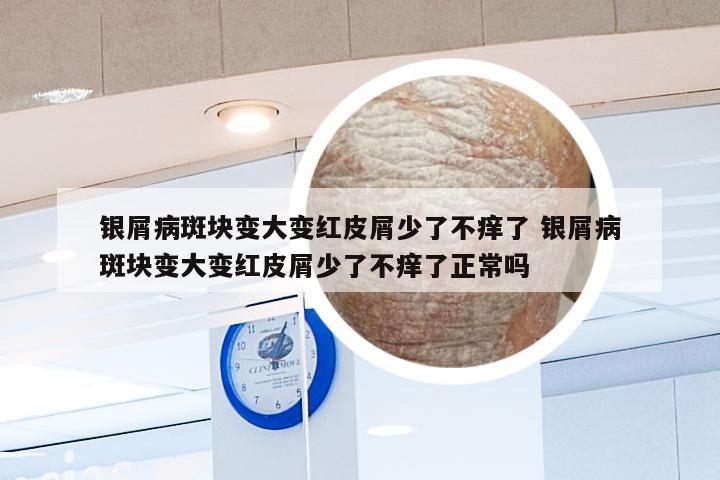 银屑病斑块变大变红皮屑少了不痒了 银屑病斑块变大变红皮屑少了不痒了正常吗