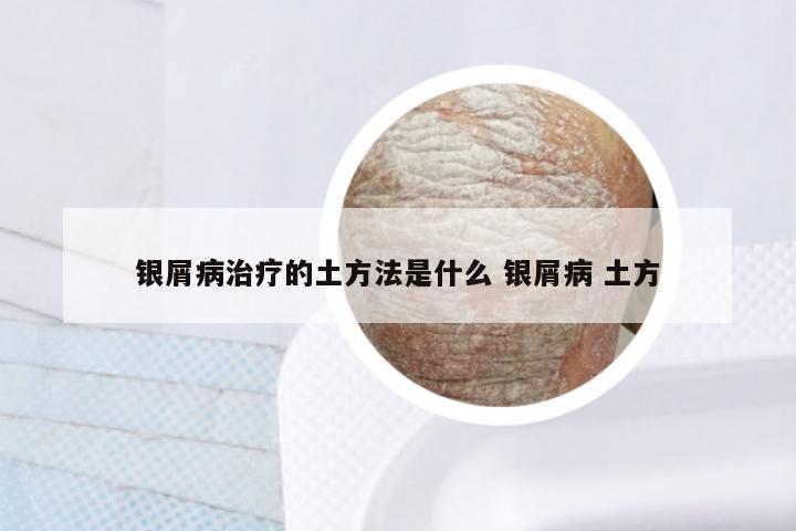 银屑病治疗的土方法是什么 银屑病 土方