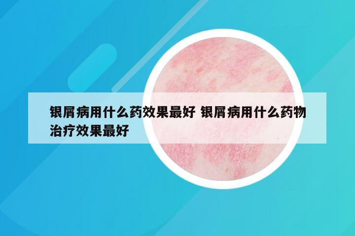 银屑病用什么药效果最好 银屑病用什么药物治疗效果最好