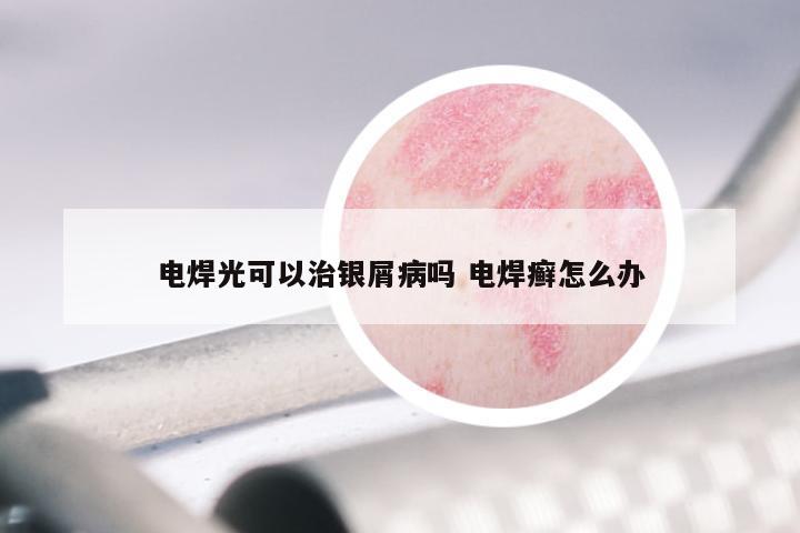 电焊光可以治银屑病吗 电焊癣怎么办