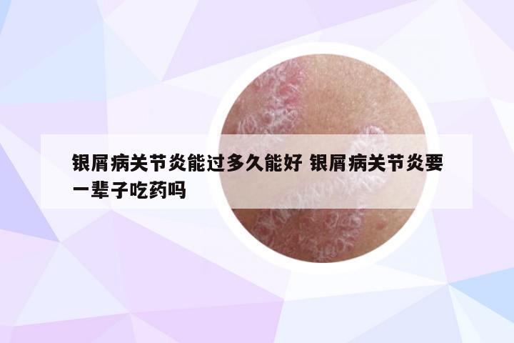 银屑病关节炎能过多久能好 银屑病关节炎要一辈子吃药吗