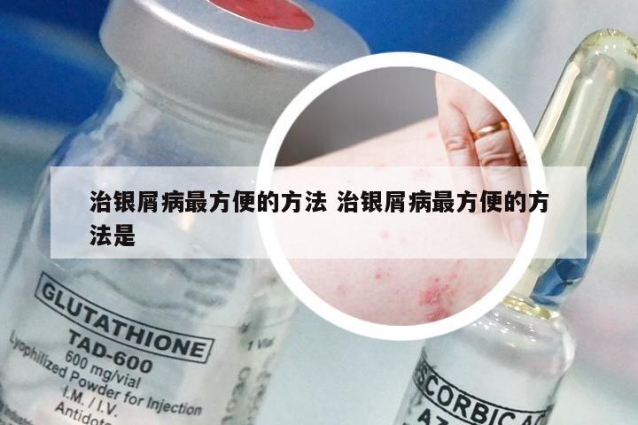 治银屑病最方便的方法 治银屑病最方便的方法是