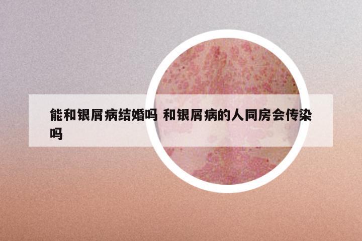 能和银屑病结婚吗 和银屑病的人同房会传染吗