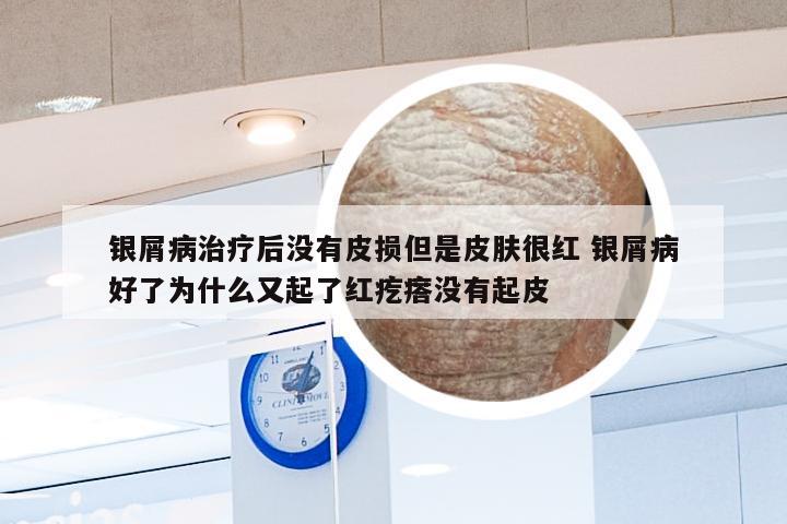 银屑病治疗后没有皮损但是皮肤很红 银屑病好了为什么又起了红疙瘩没有起皮