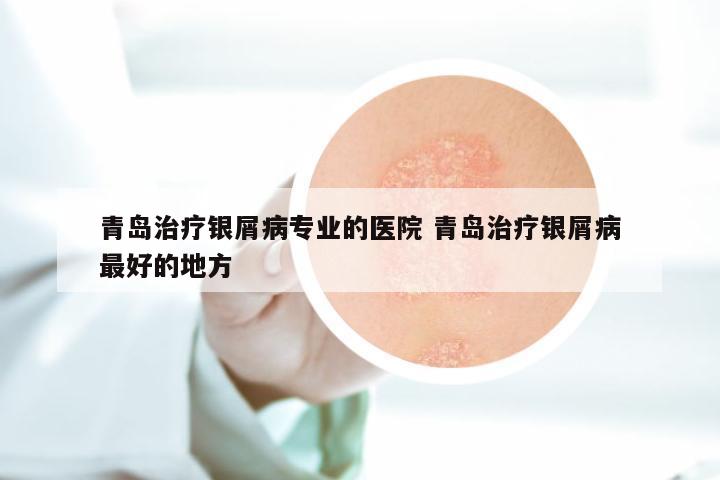 青岛治疗银屑病专业的医院 青岛治疗银屑病最好的地方