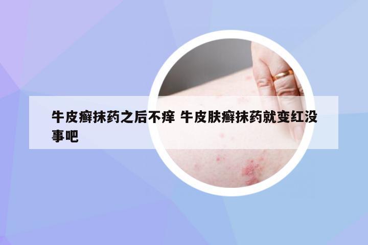 牛皮癣抹药之后不痒 牛皮肤癣抹药就变红没事吧