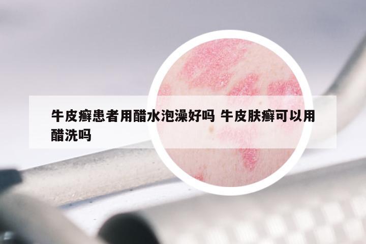 牛皮癣患者用醋水泡澡好吗 牛皮肤癣可以用醋洗吗