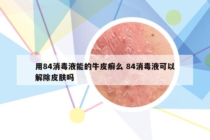 用84消毒液能的牛皮癣么 84消毒液可以解除皮肤吗