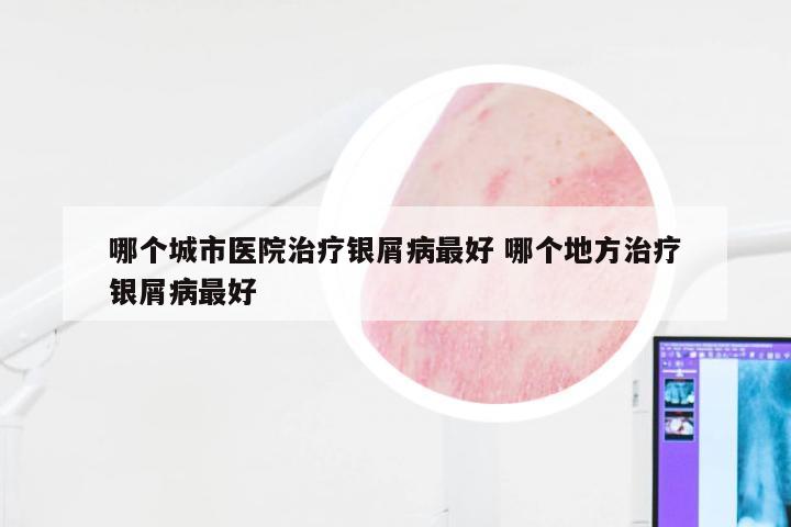 哪个城市医院治疗银屑病最好 哪个地方治疗银屑病最好