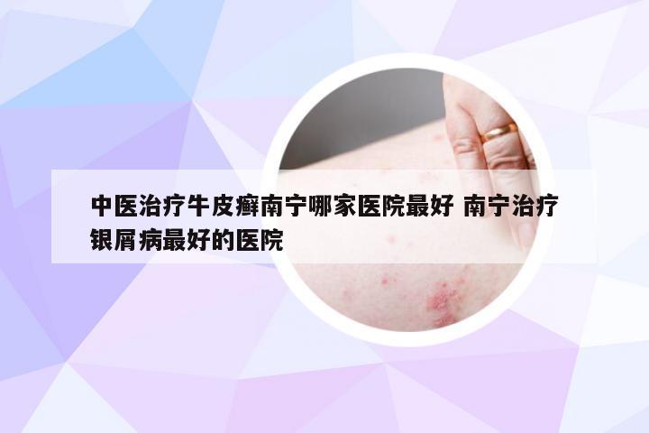 中医治疗牛皮癣南宁哪家医院最好 南宁治疗银屑病最好的医院