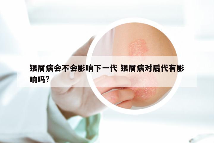银屑病会不会影响下一代 银屑病对后代有影响吗?