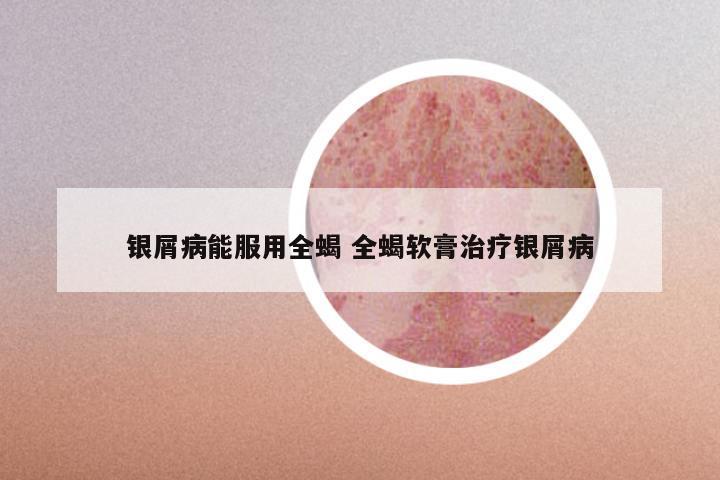 银屑病能服用全蝎 全蝎软膏治疗银屑病