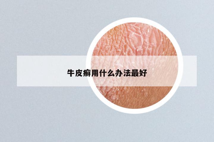 牛皮癣用什么办法最好