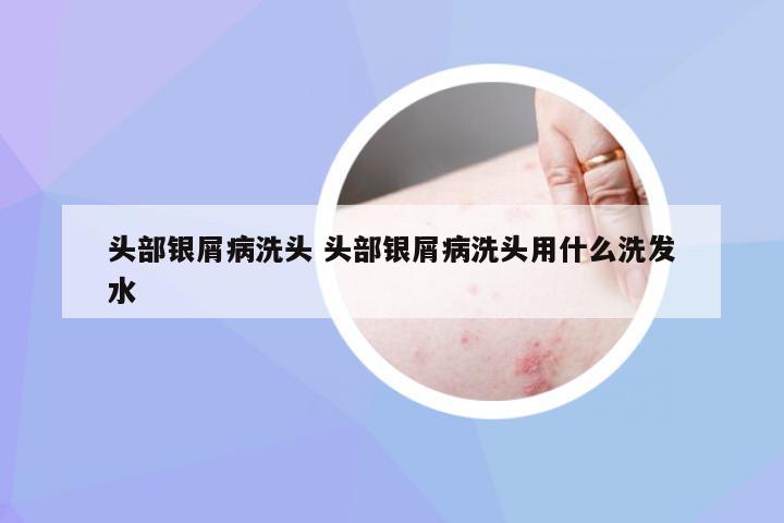 头部银屑病洗头 头部银屑病洗头用什么洗发水