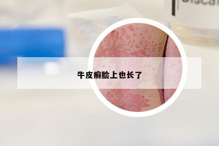牛皮癣脸上也长了