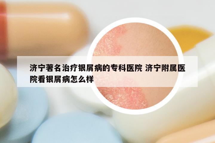 济宁著名治疗银屑病的专科医院 济宁附属医院看银屑病怎么样