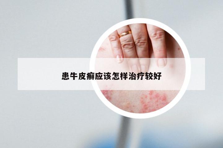患牛皮癣应该怎样治疗较好