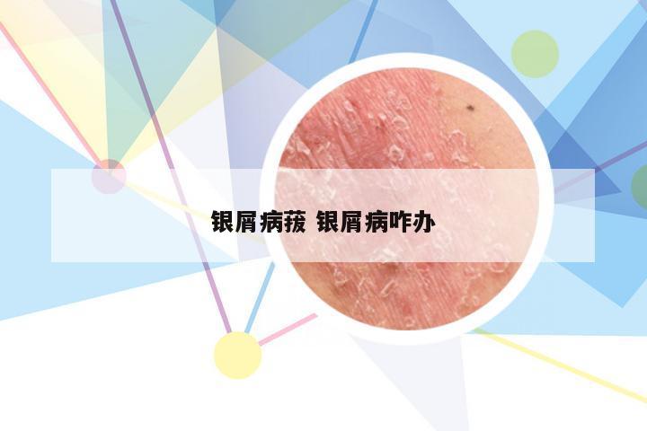 银屑病菝 银屑病咋办