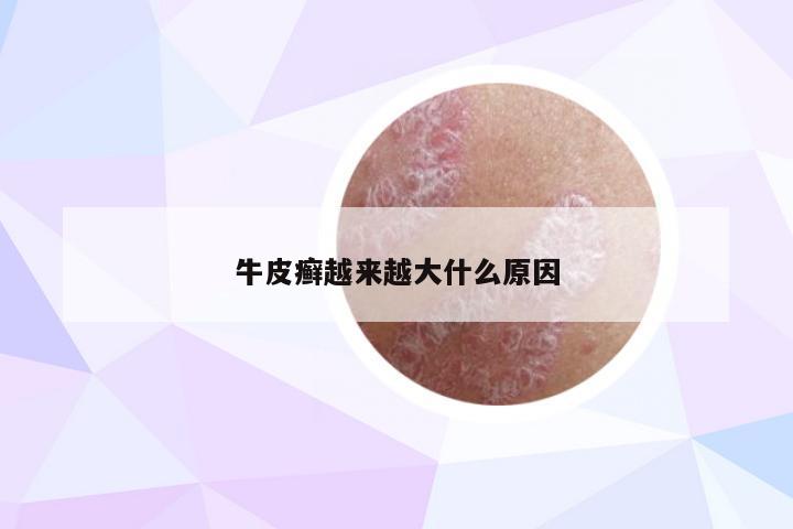 牛皮癣越来越大什么原因