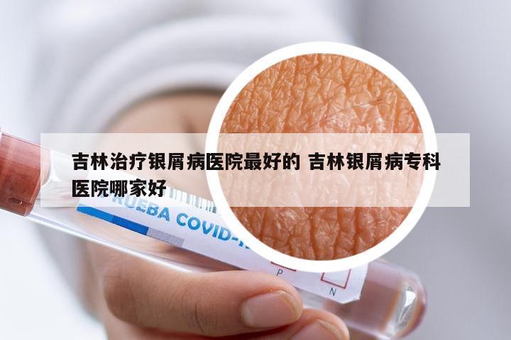吉林治疗银屑病医院最好的 吉林银屑病专科医院哪家好