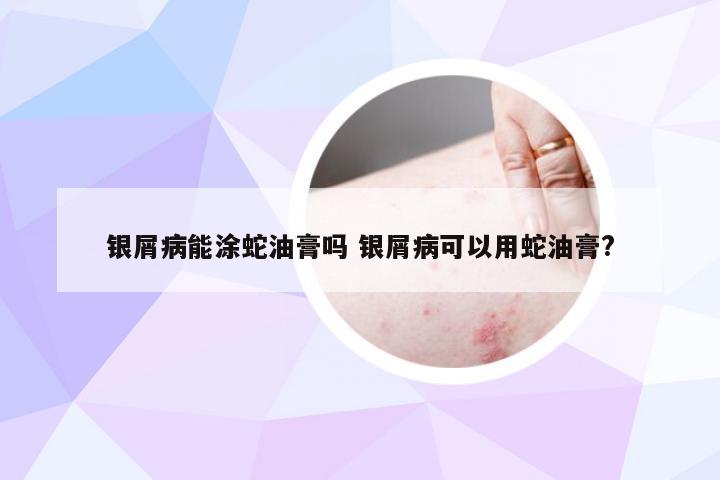 银屑病能涂蛇油膏吗 银屑病可以用蛇油膏?