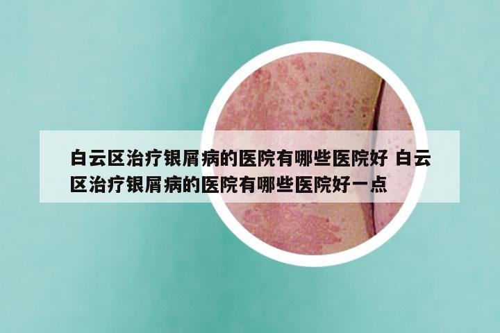 白云区治疗银屑病的医院有哪些医院好 白云区治疗银屑病的医院有哪些医院好一点