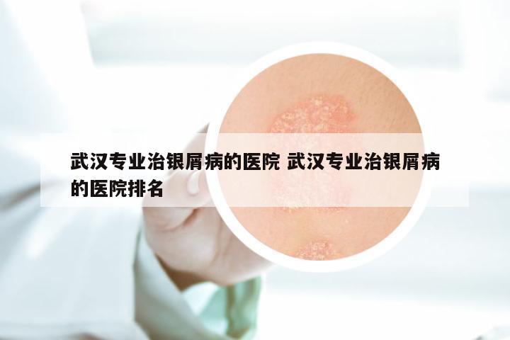 武汉专业治银屑病的医院 武汉专业治银屑病的医院排名