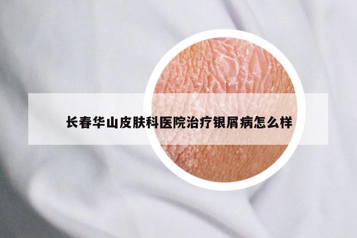 长春华山皮肤科医院治疗银屑病怎么样