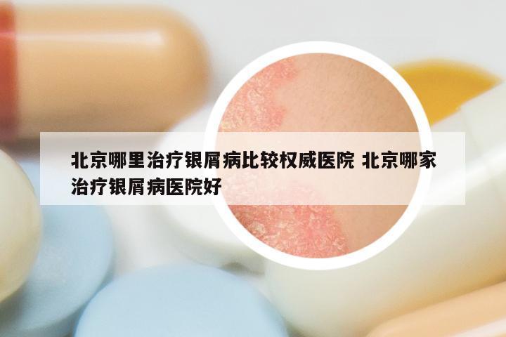 北京哪里治疗银屑病比较权威医院 北京哪家治疗银屑病医院好