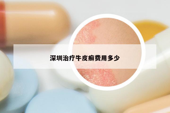深圳治疗牛皮癣费用多少