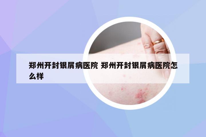 郑州开封银屑病医院 郑州开封银屑病医院怎么样