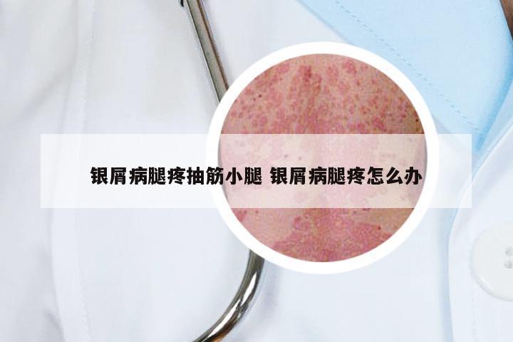 银屑病腿疼抽筋小腿 银屑病腿疼怎么办