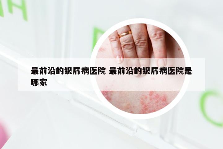 最前沿的银屑病医院 最前沿的银屑病医院是哪家