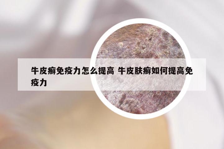 牛皮癣免疫力怎么提高 牛皮肤癣如何提高免疫力