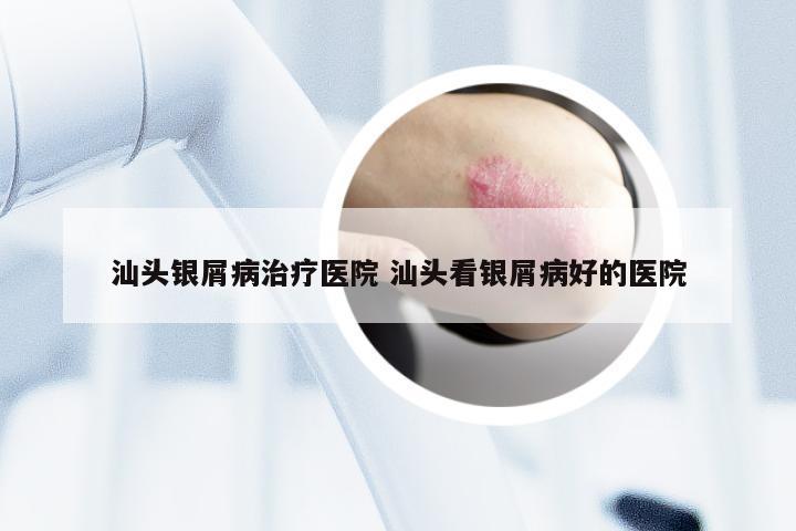 汕头银屑病治疗医院 汕头看银屑病好的医院
